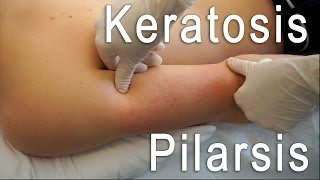 Keratosis Pilaris Clear  Brilliant Treatment FT Eric Smith  BLUSH Beverly Hills [upl. by Thursby]