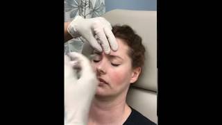 Botox to Glabella [upl. by Eibloc667]