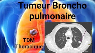 SCANNER THORACOABDOMINAL Tumeur bronchopulmonaire apicale [upl. by Truk]