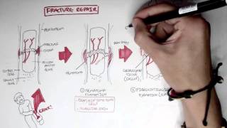 Bone Fracture  Types Fracture Repair and Osteomyelitis [upl. by Jaycee]