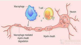 Motor Neuron Disease  Neurology [upl. by Firehs432]