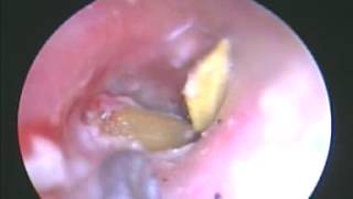 Endoscopic Foreign Body Removal from the Ear [upl. by Ydurt857]