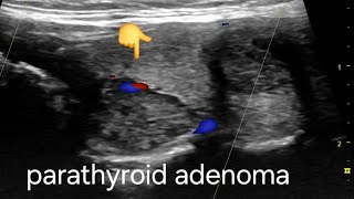 Large Parathyroid adenoma ultrasound and color Doppler video [upl. by Ardnwahs1]