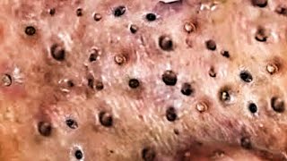 Folliculitis Ingrown Whiteheads and Pimple Popping [upl. by Chee84]