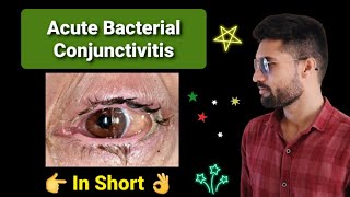 Acute bacterial Conjunctivitis lecture opthalmology [upl. by Spillar751]