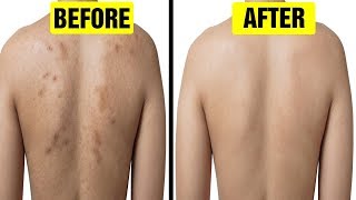 5 Best Ways to Get Rid Of Acne Scars on Back [upl. by Annazus]