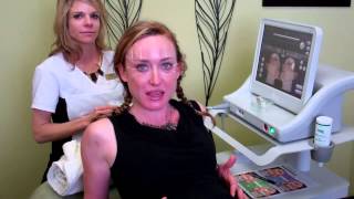 Ultherapy Brow Lift at Sonata Laser Aesthetics [upl. by Ebony974]