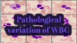 Pathological variation of WBC [upl. by Drhacir]