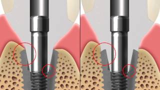 2D Manual SuperLineSE Customized abutment [upl. by Aday]