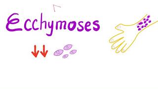 Ecchymoses  Low Platelet Count [upl. by Ivz]