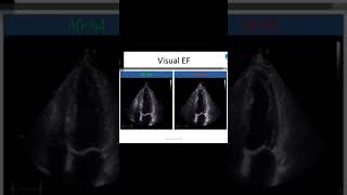 EF  Over 50 normal EF eyeball estimation visual EF ejection fraction [upl. by Idnahk]