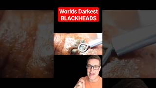 TW This Is Shocking  EXTREME BLACKHEAD REMOVAL shorts [upl. by Nnel325]