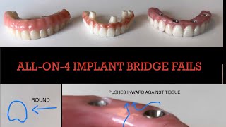 HUGE Failures with All on 4 Dental Implant Bridges [upl. by Ninnette140]