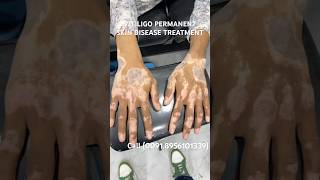 VITILIGO SKIN DISEASE PERMANENT TREATMENT  WHITE SPOTS TREATMENT  LUEKODERMA CURE vitiligocures [upl. by Suhail1]