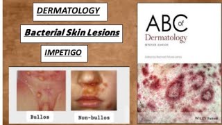 DERMATOLOGY Bacterial skin lesions  impetigo bullos nonbullos ecthyma derma impetigo [upl. by Okoyik]