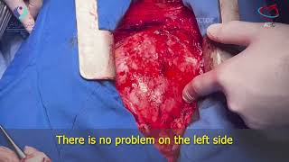 Surgical Excision of Constrictive Pericarditis B [upl. by Vanna]