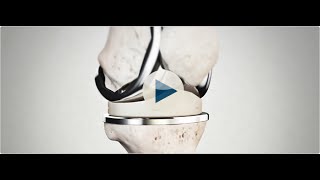 Attune Knee System [upl. by Matthei]