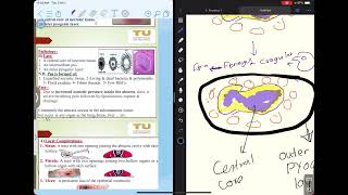 Acute suppurative inflammation [upl. by Eelra]