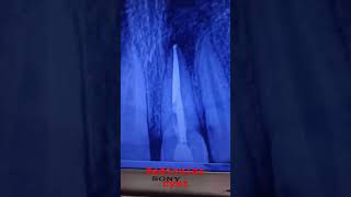 radicular cystviralshort shortvideo dentaltreatment periapical cystdentist [upl. by Rebak125]