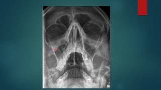 PARANASAL SINUSES RADIGRAPHY PNS X RAYS WATERS VIEW [upl. by Baoj]