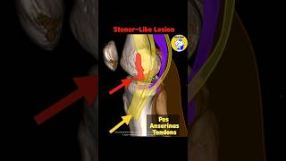 Fig 3A13 Stenerlike lesion of MCL avulsed distal MCL retracted medial to the pes tendons [upl. by Quint]