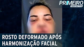 Influenciadora fica com rosto deformado após harmonização facial  Primeiro Impacto 240123 [upl. by Frick572]