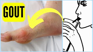 Biggest Reason People Get Gout [upl. by Kerwon]