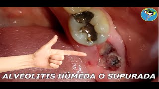 TRATAMIENTO PARA ALVEOLITIS HUMEDA Y ALVEOLITIS SECA [upl. by Archibald]