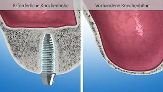 Knochenaufbau mit Sinuslift  Patienten Inform GEISTLICH [upl. by Lancey]