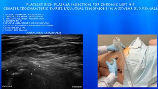 Ultrasound of Greater Trochanteric Bursitis Platelet Rich Plasma Injection in a 35 Year Old Female [upl. by Topliffe950]