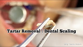 Tartar calculus removal Dental Scaling  Karang Gigi [upl. by Terza400]