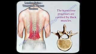 Lumbar Spine Transverse Process Fracture  Everything You Need To Know  Dr Nabil Ebraheim [upl. by Yespmed]