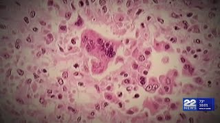 DPH First case of measles in Massachusetts since 2020 [upl. by Nani]