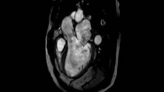 Aortic Regurgitation  Threechamber cine SSFP MR [upl. by Borman786]