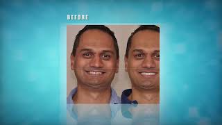 Deep Overbite Correction with VENLAY Restorations – No Surgery No Braces No Drilling or Grinding [upl. by Latini691]