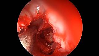 Endoscopic frontal sinusotomy [upl. by Yance653]