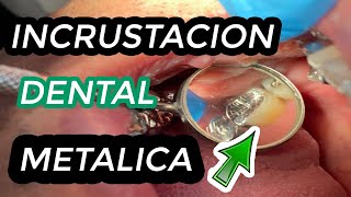 COMO se hacen las INCRUSTACIONES DENTALES METALICAS  Incrustación dental  Restauración de muela 🦷 [upl. by Colline]