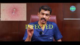 What is Sebaceous Cyst Sebaceous Cyst Explained in Tamil  DrRavindran Kumeran [upl. by Salomon]