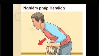 Nghiệm pháp Heimlich cấp cứu hóc dị vật [upl. by Katusha]