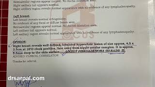 45 mm Fibroadenoma in Breast BiRads  2 Got dissolved by Homeopathy  Homeopathic Treatment [upl. by Ecirtnom]