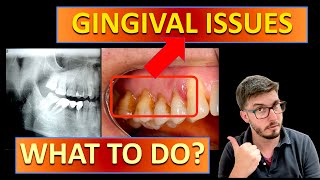 GINGIVITIS treatment vs PERIODONTITIS with TEETH STAINING gingivitis cleaning bleeding [upl. by Emorej110]