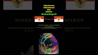 Ekokardiografi  Hipokinesia Inferolateral Dan Inferior [upl. by Idnahc]