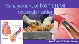 Management of Non STEMI Timing for PCI Anticoagulation antiplatelet UN VS NSTEMI [upl. by Atnoek]