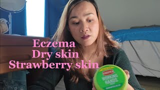 Eczema strawberry skin what I use to stop them from getting worst allergy [upl. by Undine]