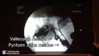 RamsayHunt Syndrome Accompanied by Dysphagia A Videofluoroscopic Swallowing Study [upl. by Eisoj]