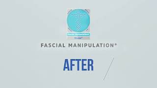 BEFORE amp AFTER FASCIAL MANIPULATION 1 [upl. by Cramer]