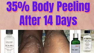 35 TCA Chemical Peel Before After Body Peeling After 14 Day पीलिंग देर से हुई [upl. by Atoked928]