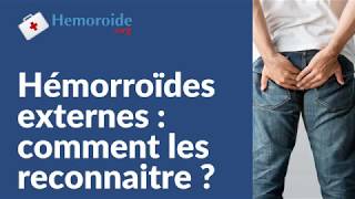 Hemorroides externes  comment les reconnaitre et les symptomes de lhemoroide externe [upl. by Anitnoc]