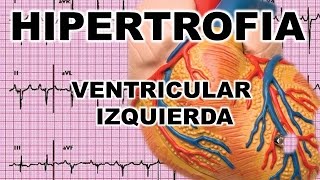 HIPERTROFIA VENTRICULAR IZQUIERDA  AUMENTO DEL TAMAÑO DEL LADO IZQUIERDO DEL CORAZÓN [upl. by Nowahs]