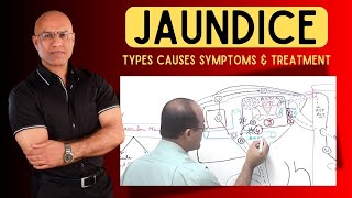 Jaundice  Types Causes Symptoms and Treatment [upl. by Lazor]